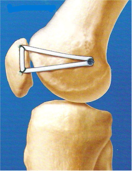 MPFL Reconstruction Diagram